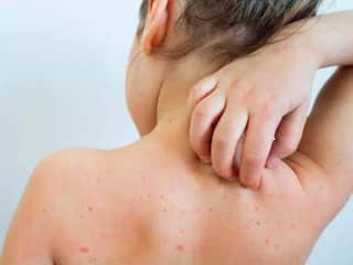 Tomato Flu : தக்காளி காய்ச்சல் பரவல்: எச்சரிக்கை விடுக்கும் நிபுணர்கள்! தமிழ்நாட்டில் பாதுகாப்பு நடவடிக்கைகள் என்னென்ன?