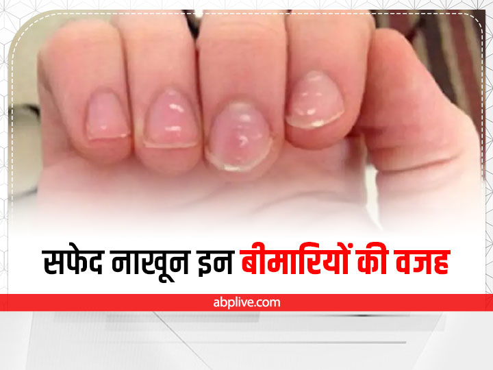 8 diseases that white spots on your nails indicate | The Times of India