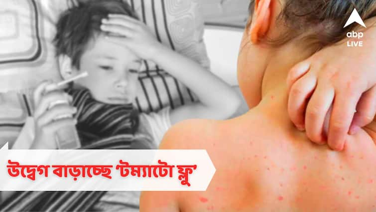 Tomato flu in kolkata many affected what is the symptoms Tomato Flu: মুখ-হাতে ফোসকা? ছোঁয়াচে এই রোগটিকে অবহেলা করলেই বিপদ!