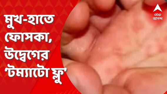 Tomato Flu : মুখ, হাত, গোড়ালি, হাঁটুতে ফোসকা, উদ্বেগ বাড়াচ্ছে ‘টম্যাটো ফ্লু’ । Bangla News