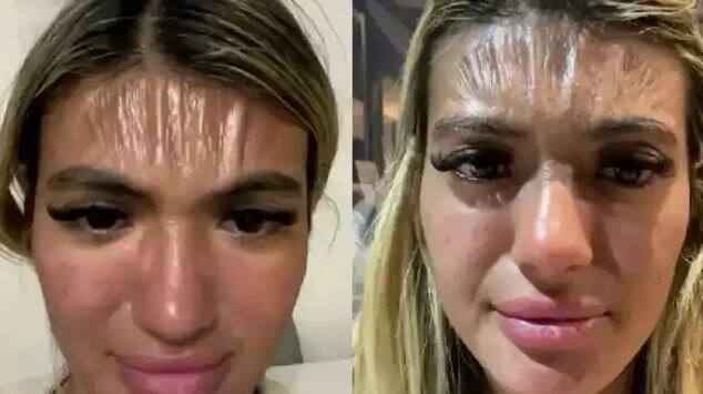 woman sleeps in sun for 30 minutes wake up with plastic skin Shocking: ਤੇਜ਼ ਧੁੱਪ 'ਚ ਬੀਚ 'ਤੇ ਸੁੱਤੀ ਪਈ ਸੀ ਔਰਤ, ਅਚਾਨਕ ਪਲਾਸਟਿਕ ਵਾਂਗ ਸੁੰਗੜ ਗਿਆ ਮੱਥਾ