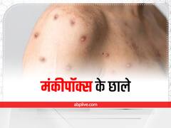 मंकीपॉक्स में होने वाले छाले शरीर पर कितने दिन रहते हैं? जानें इनके ठीक होने का समय