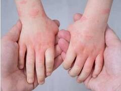 टोमैटो फीवर या टमाटर फ्लू, इसका टमाटर खाने से क्या लेना-देना है, यहां जानिए पूरा सच