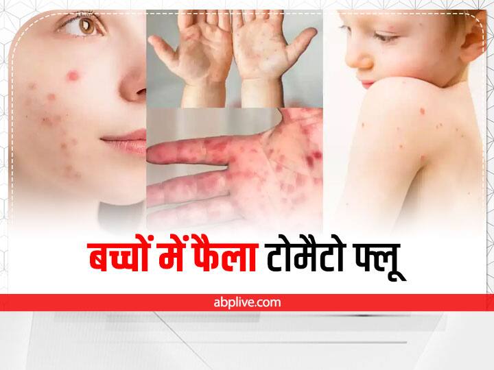 child health at risk due to tomato flu in three states of india Tomato Flu in Children: टोमैटो फ्लू की चपेट में देश के ये तीन राज्य, 5 साल तक के बच्चों में संक्रमण का अधिक खतरा