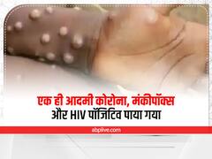 हैरान कर देगा ये मामला, एक ही आदमी को कोरोना, मंकीपॉक्स और HIV सब एक साथ हो गया