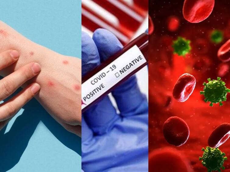 Man Tests Positive for Covid 19 Monkeypox HIV After Spain Trip First Known Case With all Three diseases at Same Time Covid Monkeypox HIV: பாதுகாப்பற்ற உடலுறவு எதிர்வினை... ஒரே நேரத்தில் ஹெச்ஐவி, குரங்கம்மை, கொரோனாவால் பாதிக்கப்பட்ட நபர்!