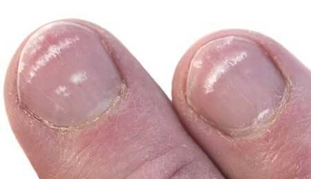 White Marks on Nails: If white marks appear on the nails, be careful, there may be many diseases. White Marks on Nails : ਜੇਕਰ ਨਹੁੰਆਂ 'ਤੇ ਦਿਖਾਈ ਦਿੰਦੇ ਨੇ ਚਿੱਟੇ ਨਿਸ਼ਾਨ ਤਾਂ ਹੋ ਜਾਓ ਸਾਵਧਾਨ, ਹੋ ਸਕਦੀਆਂ ਹਨ ਕਈ ਬੀਮਾਰੀਆਂ