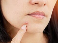 Causes of Pimples: ખીલ વધવાનું કારણ છે આપની આ મોર્નિંગ બેડ હેબિટ્સ