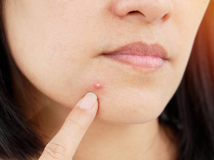 Bad Pimples Habits: આજે અમે તમને જણાવી રહ્યા છીએ કે તમારી કઈ ખરાબ આદતો છે જેના કારણે તમારે પિમ્પલ્સની સમસ્યાનો સામનો કરવો પડે છે. ચાલો જાણીએ.