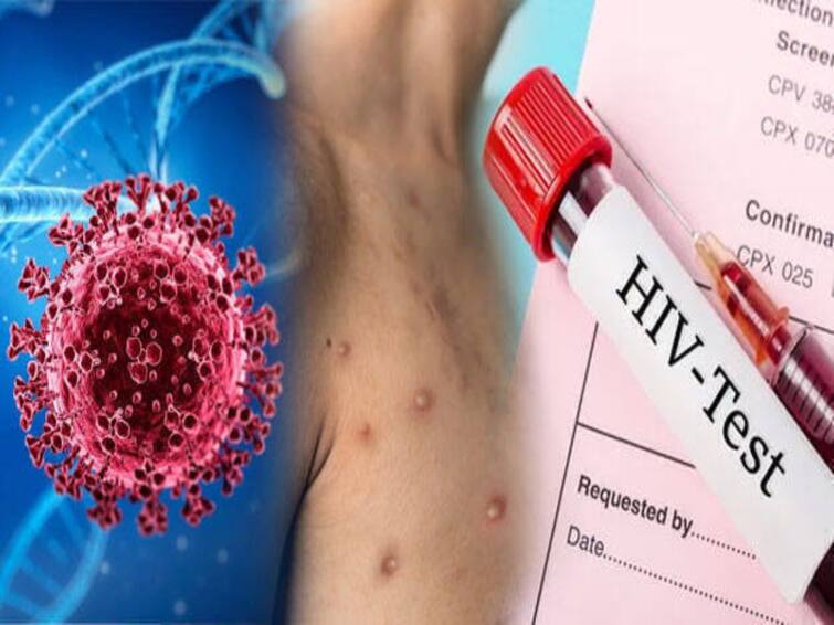 Italian man tests positive for monkeypox, Covid, HIV all at once: Report பல ஆண்களுடன் பாலுறவு.. ஒரே நேரத்தில் இளைஞருக்கு கொரோனா, குரங்கு அம்மை, எச்.ஐ.வி!