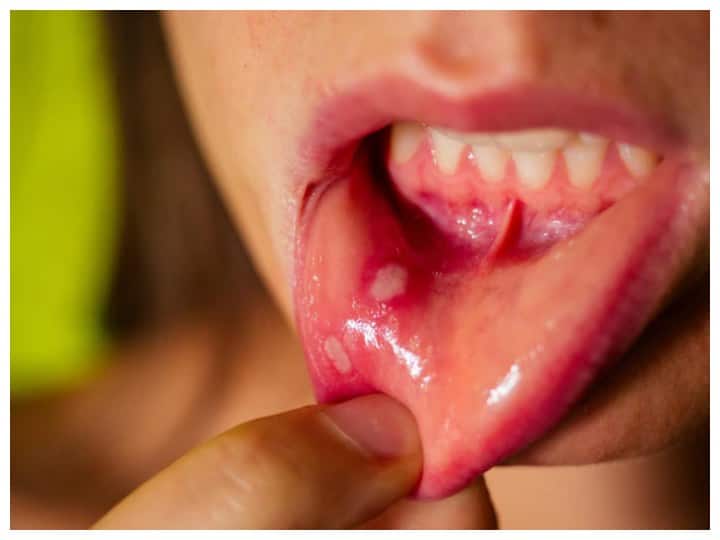 Baby Mouth Ulcers: What to do If Your Baby Has a Mouth Ulcer Baby Mouth Ulcers: बच्चों को मुंह में हो जाए छाले तो ऐसे करें बचाव, मिलेगा काफी आराम