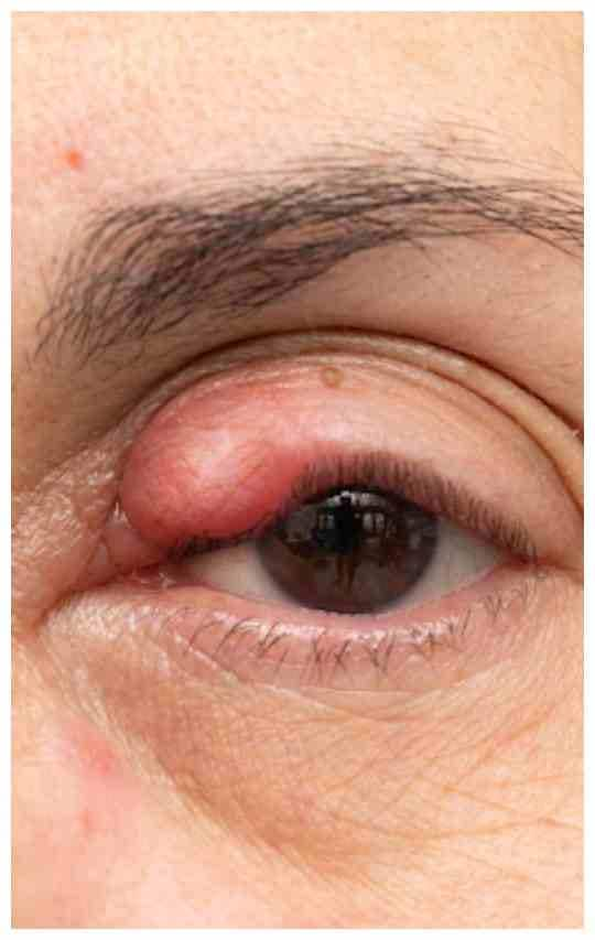 Causes of swelling of the eyelids Swelling in Eyelids: પલકો પર સોજાનું શું છે કારણ, જાણો ઉપચાર અને ઘરેલુ નુસખા