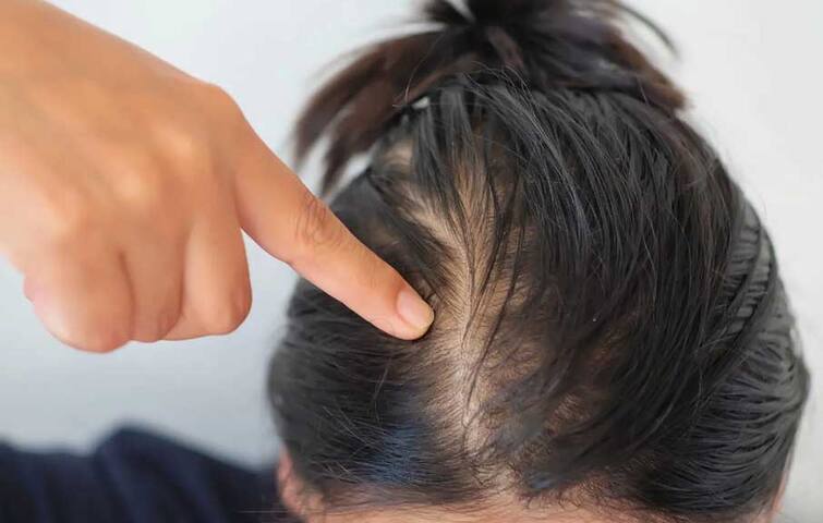 Remedies for Baldness : This hair mask can remove the problem of baldness, the effect will be visible in a few days. Remedies for Baldness : ਗੰਜੇਪਨ ਦੀ ਸਮੱਸਿਆ ਨੂੰ ਦੂਰ ਕਰ ਸਕਦੈ ਇਹ ਹੇਅਰ ਮਾਸਕ, ਕੁਝ ਹੀ ਦਿਨਾਂ 'ਚ ਦਿਖਾਈ ਦੇਵੇਗਾ ਅਸਰ