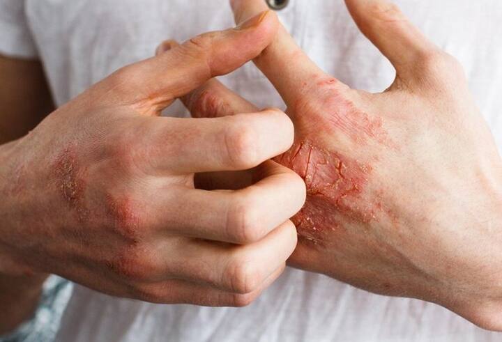 ਕੁਝ ਲੋਕਾਂ ਨੂੰ ਖਾਣ-ਪੀਣ ਦੀਆਂ ਚੀਜ਼ਾਂ ਤੋਂ ਵੀ ਐਲਰਜੀ ਹੁੰਦੀ ਹੈ। ਇਨ੍ਹਾਂ ਵਿੱਚ ਮੂੰਗਫਲੀ, ਦੁੱਧ, ਆਂਡੇ (Peanuts, Milk, Eggs) ਆਦਿ ਸ਼ਾਮਲ ਹਨ।