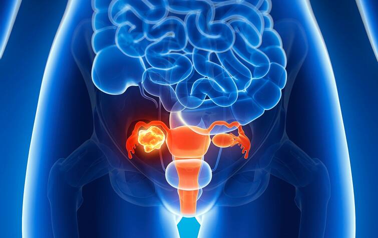 Ovarian Cancer: Women rarely pay attention to these symptoms of ovarian cancer, but ignoring them can be fatal. Ovarian Cancer : ਓਵੇਰੀਅਨ ਕੈਂਸਰ ਦੇ ਇਨ੍ਹਾਂ ਲੱਛਣਾਂ ਵੱਲ ਘੱਟ ਹੀ ਧਿਆਨ ਦਿੰਦੀਆਂ ਨੇ ਔਰਤਾਂ, ਪਰ ਨਜ਼ਰਅੰਦਾਜ਼ ਕਰਨਾ ਹੋ ਸਕਦੈ ਘਾਤਕ