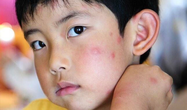 ਐਲਰਜੀ ਕਈ ਤਰ੍ਹਾਂ ਦੀ ਜਿਵੇਂ ਚਮੜੀ ਦੀ ਐਲਰਜੀ, ਧੂੜ ਦੀ ਐਲਰਜੀ ਅਤੇ ਭੋਜਨ ਦੀ ਐਲਰਜੀ। ਐਲਰਜੀ ਦੇ ਕਾਰਨ ਸਰੀਰ 'ਤੇ ਧੱਫੜ, ਧੱਫੜ ਅਤੇ ਧੱਫੜ, ਜ਼ੁਕਾਮ-ਖਾਂਸੀ, ਛਿੱਕ ਆਉਣਾ ਅਤੇ ਸੋਜ ਦੀ ਸਮੱਸਿਆ ਹੁੰਦੀ ਹੈ।