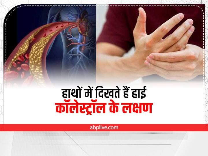 What are the signs of high cholesterol in the hands High Cholesterol Signs: हाथों में दिखें इस तरह के संकेत, तुरंत करें डॉक्टर से संपर्क