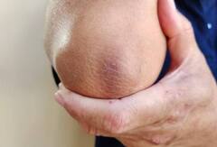 Dark Elbows : ਕੀ ਕੂਹਣੀ ਦੇ ਕਾਲੇਪਣ ਕਾਰਨ ਤੁਹਾਨੂੰ ਵੀ ਹੋਣਾ ਪੈ ਰਿਹੈ ਸ਼ਰਮਿੰਦਾ, ਅਪਣਾਓ ਇਹ ਘਰੇਲੂ ਨੁਸਖੇ