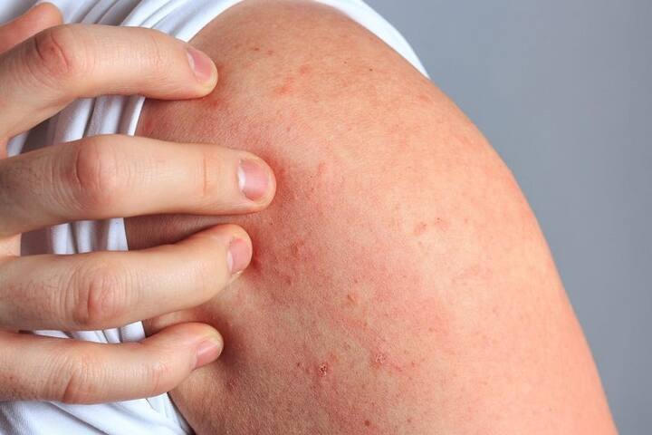 ਐਲਰਜੀ ਹੋਣਾ ਇੱਕ ਆਮ ਸਮੱਸਿਆ ਹੈ। ਇਹ ਕੋਈ ਵੀ ਹੋ ਸਕਦੀ ਹੈ। ਇਸ ਦੇ ਨਾਲ ਹੀ ਇੱਥੇ ਇਹ ਜਾਣਨਾ ਵੀ ਜ਼ਰੂਰੀ ਹੈ ਕਿ ਕਈ ਤਰ੍ਹਾਂ ਦੀਆਂ ਐਲਰਜੀਆਂ ਹੁੰਦੀਆਂ ਹਨ।