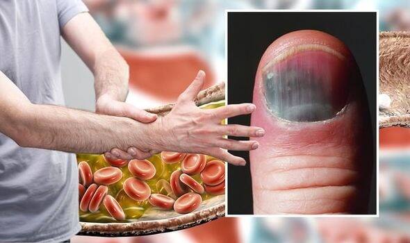 ਇਸਦੇ ਕਾਰਨ, ਖੂਨ ਦੀਆਂ ਨਾੜੀਆਂ ਬਲਾਕ ਹੋ ਸਕਦੀਆਂ ਹਨ, ਜੋ ਤੁਹਾਡੇ ਦਿਲ ਤੋਂ ਲੈ ਕੇ ਪੂਰੇ ਸਰੀਰ ਨੂੰ ਪ੍ਰਭਾਵਿਤ ਕਰ ਸਕਦੀਆਂ ਹਨ।