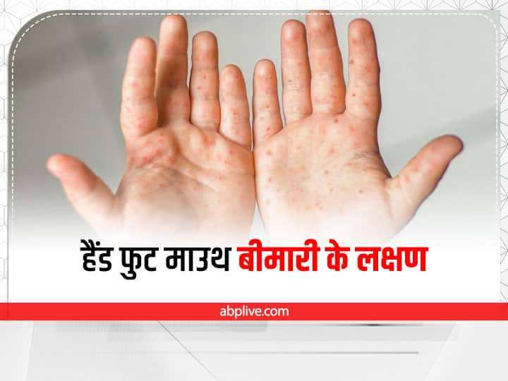 Hand Foot And Mouth Disease In Kids Noida Schools Symptoms Quarantine Period Recovery Signs Hand Foot Mouth Disease: नोएडा में बच्चों में बढ़े हैंड फुट एंड माउथ यानि HFMD के मामले, ये हैं लक्षण