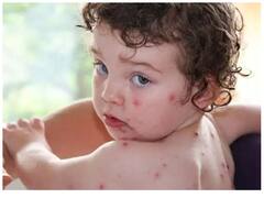 Tomato Flu: टोमैटो फ्लू के क्या हैं लक्षण और कैसे बरतें सावधानी