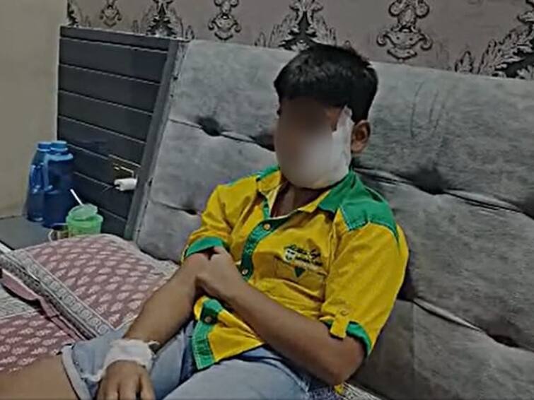 Pet pitbull bites 11 year old Ghaziabad boy face child gets 150 stitches சிறுவனின் முகத்தை கடித்துக் குதறிய பிட்புல் இன நாய்..! 150 தையல்கள்..!. அதிர்ச்சி வீடியோ!