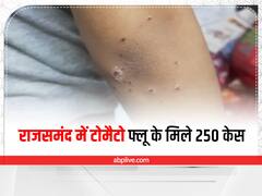 मंकीपॉक्स के बाद टोमैटो फ्लू बीमारी का बच्चों में बढ़ा खतरा, राजसमंद में 250 केस आए सामने