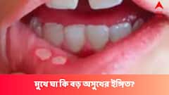 মুখে ঘা ফিরে ফিরে আসছে, বড় কোনও রোগের লক্ষণ নয় তো ?