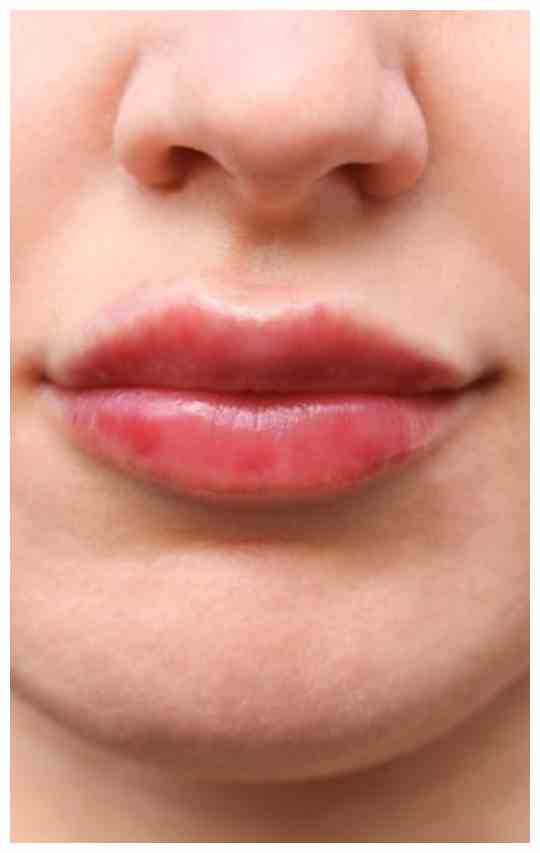 herpes-on-lips-stages-lipstutorial