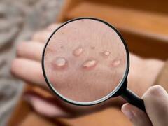 दिल्ली में मंकीपॉक्स का एक और मामला आया सामने, नाइजीरियाई महिला संक्रमित