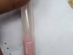 MP News: डेढ़ साल की अनाया के रगो में दौड़ रहा सफेद खून, डॉक्टर भी रह गए हैरान