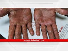 फंगल इन्फेकशन झालेय? काय घ्याल काळजी? वाचा तज्ज्ञ काय सांगतात