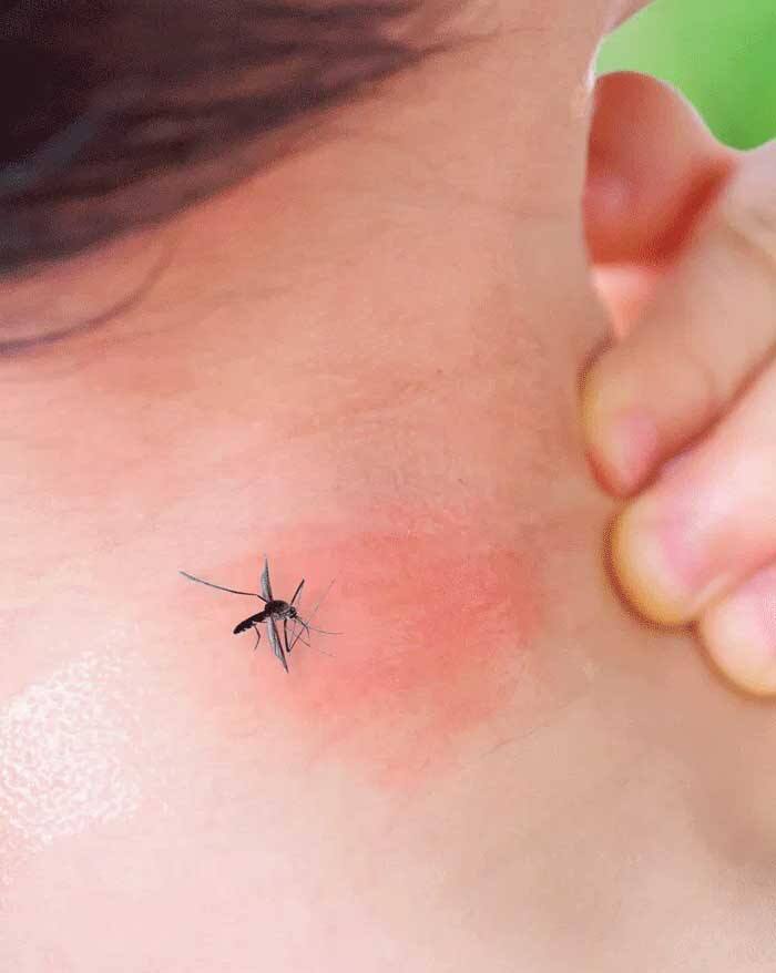 ਮੱਛਰ ਦੇ ਕੱਟਣ ਦੇ 3 ਤੋਂ 5 ਦਿਨਾਂ ਬਾਅਦ ਮਰੀਜ਼ ਨੂੰ ਬੁਖਾਰ ਹੋਣ ਲੱਗਦਾ ਹੈ। ਜਿਸ ਤੋਂ ਬਾਅਦ 10 ਦਿਨਾਂ 'ਚ ਇਹ ਬਿਮਾਰੀ ਸਰੀਰ ਦੇ ਅੰਦਰ ਵਧਣੀ ਸ਼ੁਰੂ ਹੋ ਜਾਂਦੀ ਹੈ।