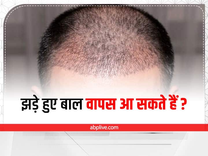 Trending news: Causes of hair loss at an early age and ways to prevent it -  Hindustan News Hub