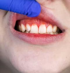 Platelets Count : ਇੱਕ ਆਮ ਵਿਅਕਤੀ 'ਚ ਕਿੰਨਾ ਹੋਣਾ ਚਾਹੀਦੇ ਪਲੇਟਲੈਟ ਕਾਊਂਟ ? ਆਓ ਜਾਣੀਏ ਇਸਨੂੰ ਵਧਾਉਣ ਦਾ ਤਰੀਕਾ