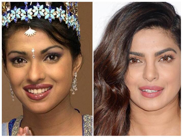 चेहरे की खूबसूरती में नाक की शेप बहुत मैटर करती है. अगर आपको अपनी नोज की शेप पसंद नहीं है तो नोज सर्जरी करवा सकते हैं. लिप सर्जरी का युवाओं में बहुत क्रेज है.