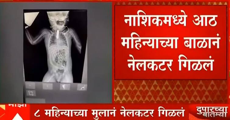 Maharashtra News Nashik news baby swallows nail cutter doctor operated using surgery in nashik Nashik News : खेळता खेळता बाळानं नेलकटर गिळलं! नाशिकमध्ये डॉक्टरांनी शस्त्रक्रिया करत वाचवलं!