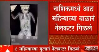 Nashik News : खेळता खेळता बाळानं नेलकटर गिळलं! नाशिकमध्ये डॉक्टरांनी शस्त्रक्रिया करत वाचवलं!