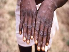 राजधानी दिल्ली में तेजी से पांव पसार रहा मंकीपॉक्स, अब तक समाने आए इतने मरीज