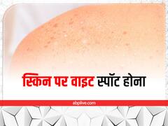 क्यों होती है सफेद दाग की समस्या, क्या हैं इसके कारण और कैसे पाएं निजात?