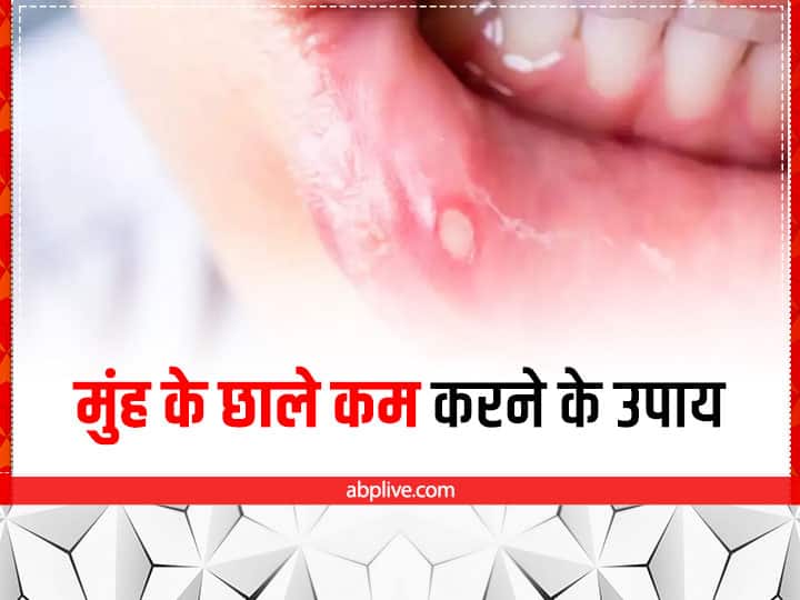 Mouth Ulcer Home Remedies in Hindi दादी-नानी के नुस्खों में है बड़ा दम, मुंह के छालों को कुछ ही दिनों में कर सकता है कम