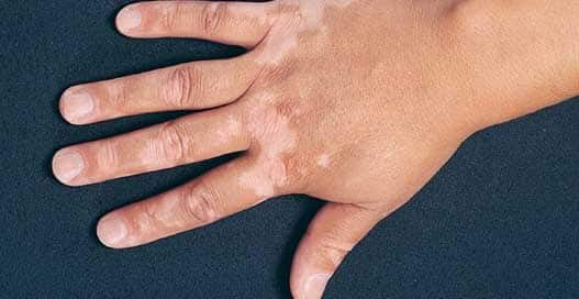 Vitiligo: Why is the problem of white spots, what is its cause and how to get rid of it? Vitiligo : ਕਿਉਂ ਹੁੰਦੀ ਐ ਚਿੱਟੇ ਧੱਬਿਆਂ ਦੀ ਸਮੱਸਿਆ, ਕੀ ਨੇ ਇਸਦੇ ਕਾਰਨ ਤੇ ਇਸ ਤੋਂ ਕਿਵੇਂ ਪਾਇਆ ਜਾ ਸਕਦਾ ਛੁਟਕਾਰਾ ?