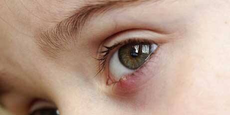 Stye in Eye: Are you bothered by the recurring finsiness on the eyes? Get relief with these easy ways Stye in Eye : ਕੀ ਅੱਖਾਂ 'ਤੇ ਵਾਰ-ਵਾਰ ਹੋ ਰਹੀ ਫਿਨਸੀ ਤੋਂ ਹੋ ਪਰੇਸ਼ਾਨ ? ਇਨ੍ਹਾਂ ਆਸਾਨ ਤਰੀਕਿਆਂ ਨਾਲ ਪਾਓ ਰਾਹਤ