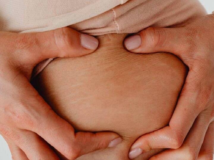 DIY: How to reduce stretch marks ஸ்ட்ரெட்ச் மார்க்ஸ் பிரச்சினையா? சரி செய்ய எளிய டிப்ஸ்