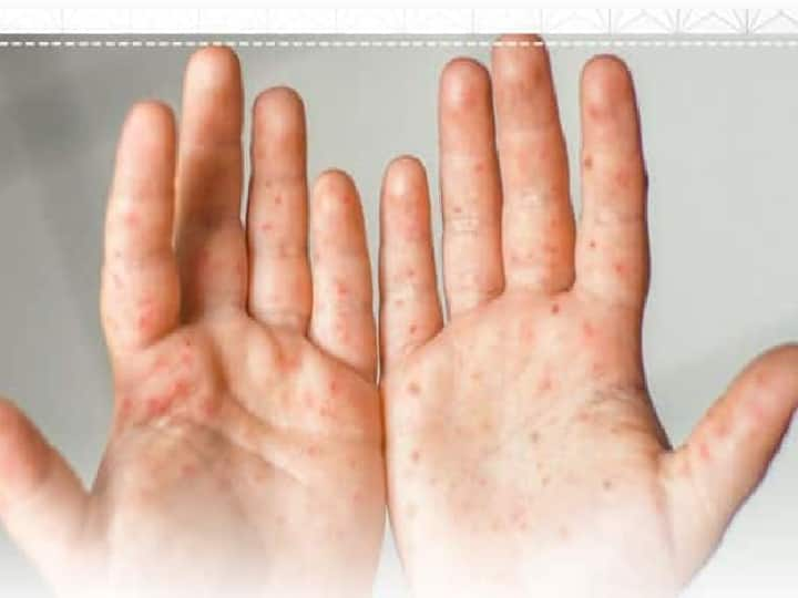 HFMD  mouth hands and feet mild, contagious viral infection common in children अंगावर फोड आणि ताप! मुलांमध्ये वाढतोय HFMD आजार; काय आहेत लक्षणं आणि उपाय