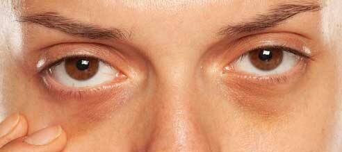 Dark Circles Home Remedy: Remove the dark circles under the eyes with these things kept in the kitchen, the beauty will increase in a few days. Dark Circles Home Remedy : ਰਸੋਈ 'ਚ ਰੱਖੀਆਂ ਇਨ੍ਹਾਂ ਚੀਜ਼ਾਂ ਨਾਲ ਦੂਰ ਕਰੋ ਅੱਖਾਂ ਦੇ ਹੇਠਾਂ ਹੋਏ ਕਾਲੇ ਘੇਰੇ, ਕੁਝ ਹੀ ਦਿਨਾਂ 'ਚ ਵਧੇਗੀ ਖੂਬਸੂਰਤੀ