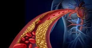 Health tips: શરીરમાં દેખાતા આ લક્ષણો હાઇકોલેસ્ટ્રોલના આપે છે સંકેત, ઓછું કરવા કરો આ ઉપાય