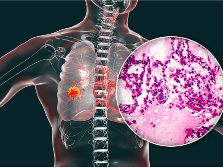 Smoking Biggest Cause Of Lung Cancer, But Not The Only One. Know About Other Factors, Treatments Smoking Biggest Cause Of Lung Cancer, But Not The Only One. Know About Other Factors, Treatments