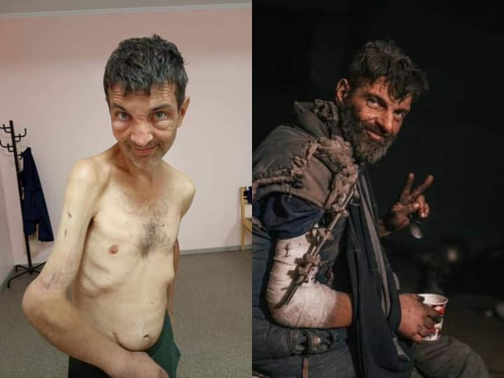 Ukraine soldier Mykhailo Dianov before and after Russian captivity in photos Russia-Ukraine War: रूस की कैद का कहर, हड्डियों के ढांचे में नजर आया यूक्रेनी सैनिक